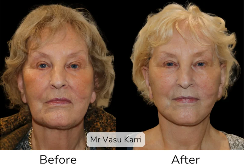 Facelift Patient 13 View 1